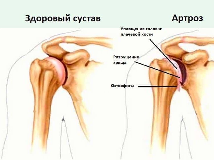 ARTRETYZM czy …..GIMNASTYKA?